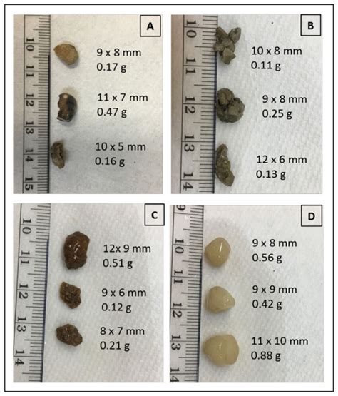 Kidney Stone Chart: A Visual Reference of Charts | Chart Master