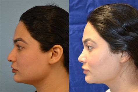 Nose Surgery Before & After Photos Patient 189 | San Francisco, CA ...