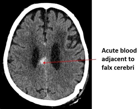 Ct Brain Anatomy - Anatomy Reading Source