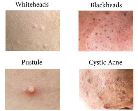 Dr. Pimple Popper Reveals the Acne You Shouldn't Pop | Reader's Digest