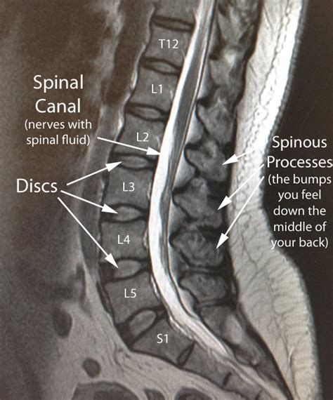 lumbar normal sag mri w text | CoreWalking