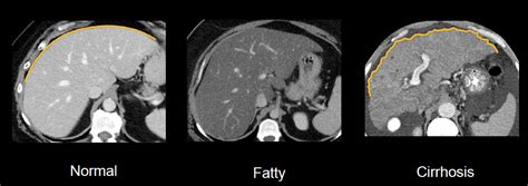 Abdominal CT: Liver • LITFL • Radiology library