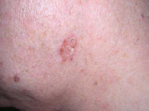 Actinic Keratosis Appearance vs. Squamous Cell Carcinoma » Scary Symptoms