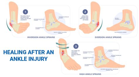 How to Heal a Ankle Injury using Sprain Ankle Treatment