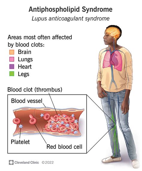 Lupus Anticoagulant Antibodies And Repeated Miscarriage, 51% OFF