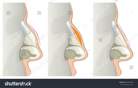 Nose Surgery Stock Vector (Royalty Free) 436028440 | Shutterstock