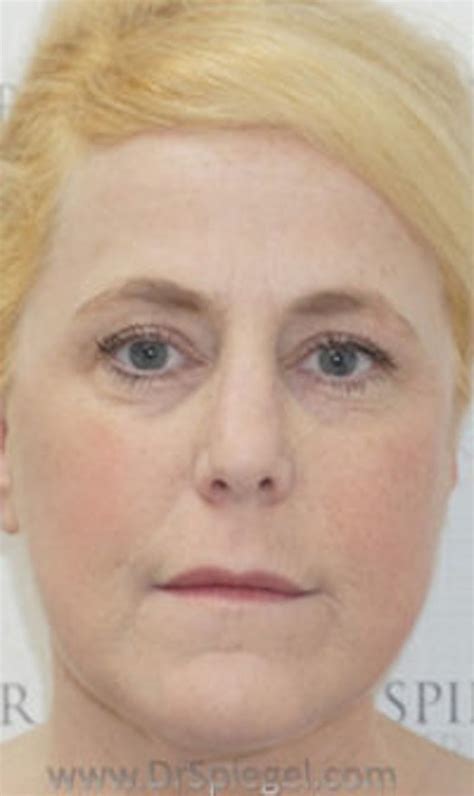 Patient 183935111 | Liquid Face Lift Before & After Photos | The Spiegel Center