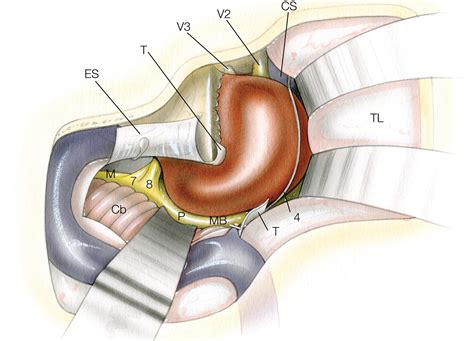 Petroclival Meningioma: Posterior Petrosal Approach | The Neurosurgical Atlas