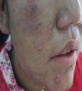 Charlotte Bronte Igazságügyi orvostan nehéz leprosy skin lesions díj az én Sirály