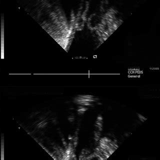 7 Intracardiac echocardiography for evaluation of the pulmonary valve.... | Download Scientific ...