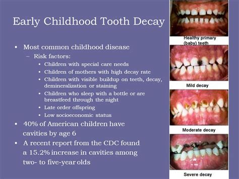 stages of tooth decay in children