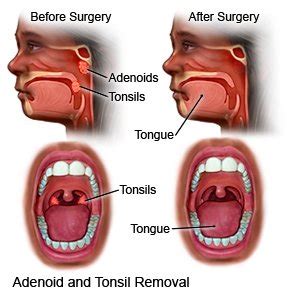 tonsil removal surgery - Jeffrey Decarvalho