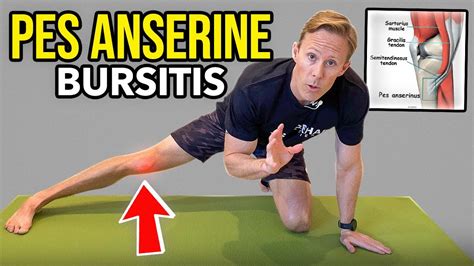 Knee Pes Anserine Bursitis Exercises Illustration Bursitis Knee | sexiezpix Web Porn