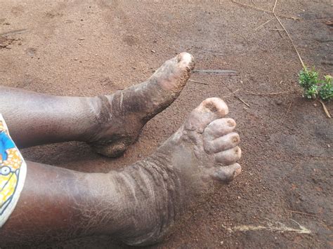 Cases of 'Elephantiasis' Traced to Unexpected Cause | Live Science