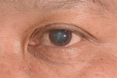 Diabetes and Eyes: Symptoms of Diabetic Cataract