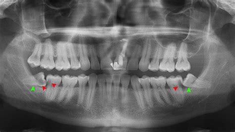 Impacted Wisdom Teeth X Ray