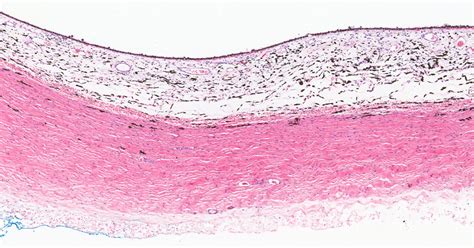 Eye – Retina, Choroid and Sclera – NUS Pathweb :: NUS Pathweb