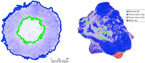 Tumor anatomy in spheroid models and human tumors. (A) Tumor spheroid... | Download Scientific ...