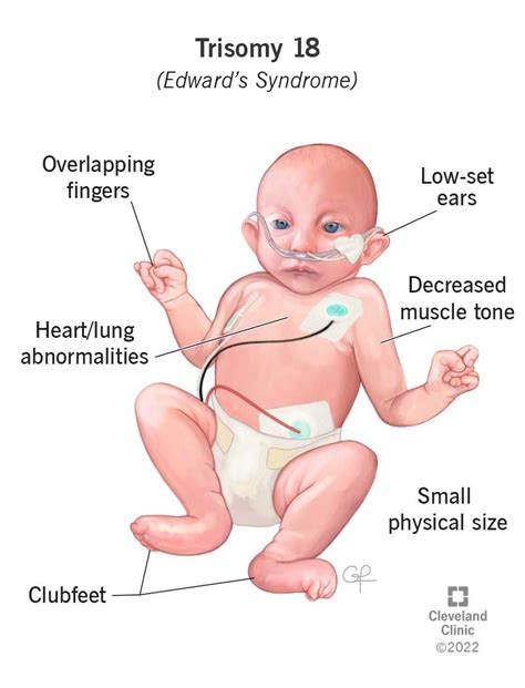 Understanding Edwards' Syndrome: Causes, Symptoms, and Treatment - Ask The Nurse Expert