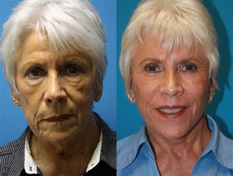 Facelift Before and After Pictures Case 70 | Charleston, SC | Crantford Costa Plastic Surgery