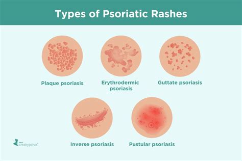 Psoriatic Arthritis Rash: Symptoms, Treatment, and Pictures