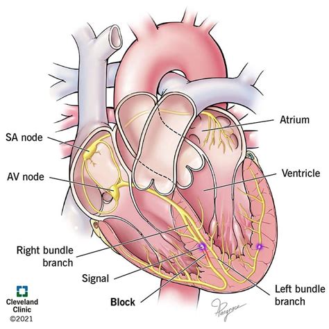 Right Bundle Branch Block: What Is It, Causes, Symptoms & Treatment