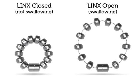 LINX® Reflux Management System - Esophageal Institute of Atlanta, C. Daniel Smith, MD, FACS