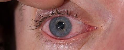 Symptoms of a Scratched Cornea - Eye Center of Texas