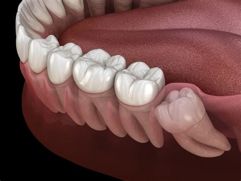 Should You Have Your Wisdom Teeth Removed? - Tuxedo Dental Group