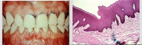 Mucogingival Junction Histology