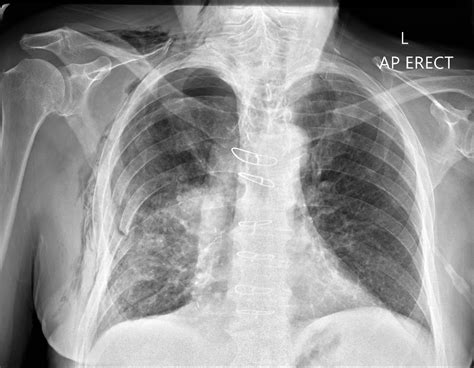 Loss of Lung Markings | Chest X-Ray - MedSchool