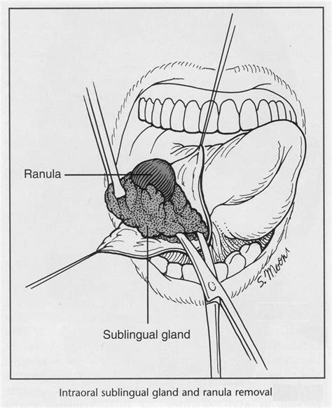 Sublingual Gland Removal – Exodontia