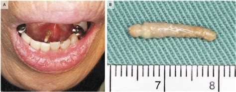 Sublingual Caruncle Swelling