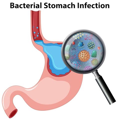 Stomach Bacteria Types