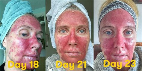 These Graphic Photos Of Skin Precancer Treatment Are A Must-See | SELF