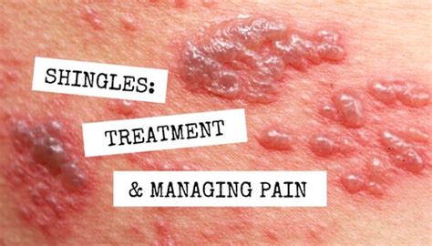 Shingles: Treatment and Managing Pain | WCEI