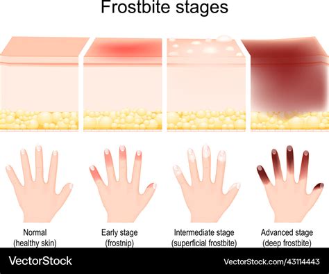 First Degree Frostbite