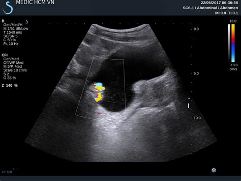 VIETNAMESE MEDIC ULTRASOUND: CASE 439: URINARY BLADDER TUMOR, Dr PHAN THANH HẢI, MEDIC MEDICAL ...