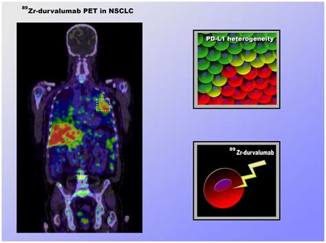 Pet Scan Images Lung Cancer