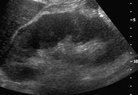 Pyelonephritis: Radiologic-Pathologic Review | RadioGraphics