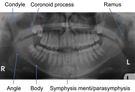 The Facial Bones