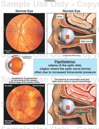 Papilledema - Pictures, Definition, Causes, Symptoms and Treatment