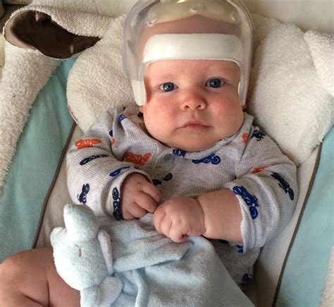 Baby's odd head shape signaled serious medical condition - CBS News