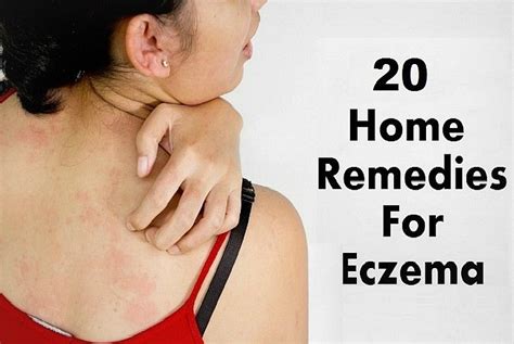 20 Best Natural Home Remedies for Eczema in Adults