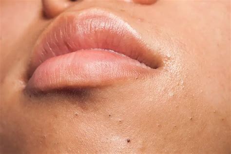 Blackheads On Chin - Causes, Facts And Home Remedies