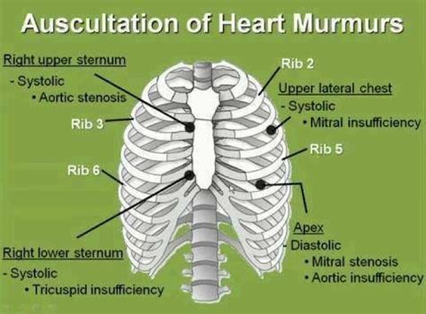 Auscultation of heart murmurs Aortic Stenosis, Nursing Board, Nursing ...