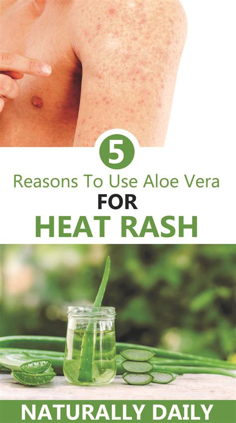 Home Remedies For Heat Rash - Riset