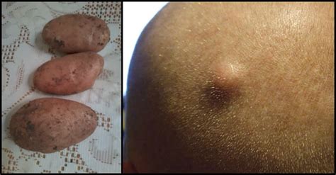 Sebaceous Cyst Sebaceous Hyperplasia Apple Cider Vinegar Before And After : Natural Sebaceous ...