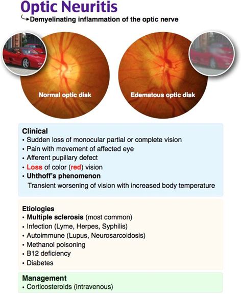 Rosh Review | Optic neuritis, Optometry education, Opthalmic technician