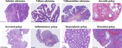 Different types of colonic polyps with hematoxylin-eosin staining | Download Scientific Diagram